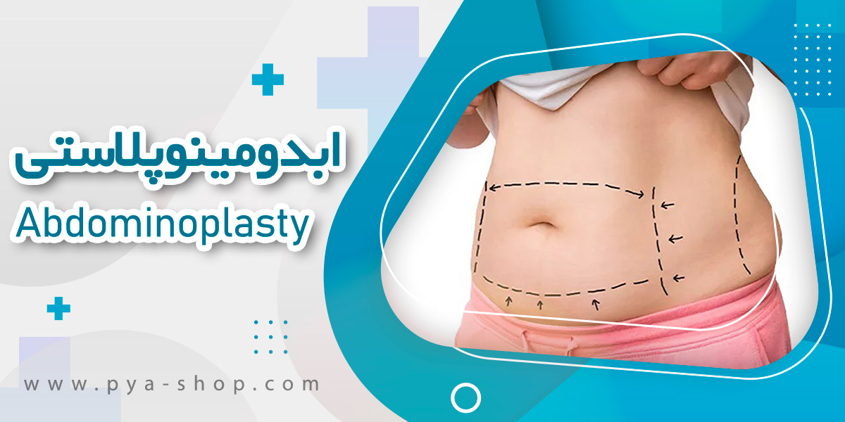 ابدومینوپلاستی Abdominoplasty چیست؟به چه نکاتی باید توجه کرد!